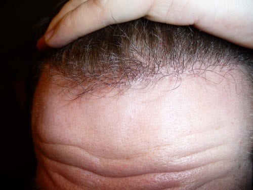 Les endroits les plus exposés à la perte de cheveux