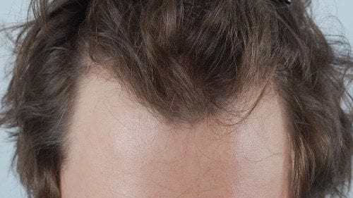 Les Endroits Les Plus Exposes A La Perte De Cheveux